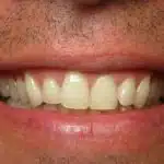 Close-up of male patient's smile displaying natural teeth and gum line for dental evaluation.