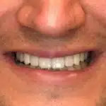 Close-up of person's smile showing teeth and gum line in dental care context.