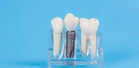 5 Common Dental Implant Myths You Should Stop Believing