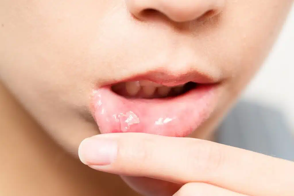 Oral Ulcers